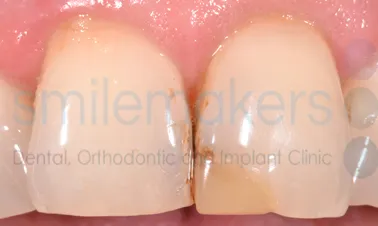 A closeup of two front teeth, with the one on the right having been filled in but is now discoloured