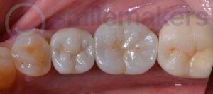 BackTeeth 1 After Compressed 300x133 2
