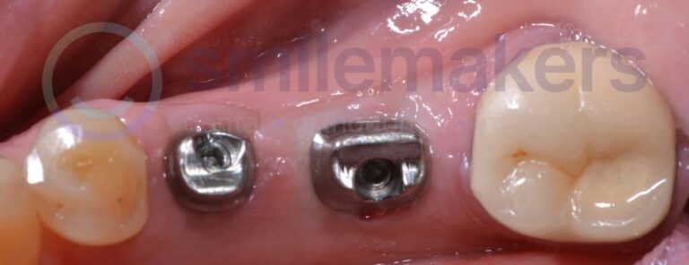 BackTeeth 1 Before Compressed 768x296 2