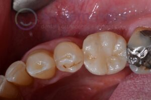 BackTeeth 2 After Compressed 300x200 2