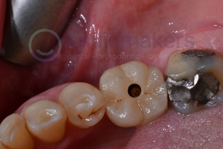 BackTeeth 2 Before Compressed 768x512 2