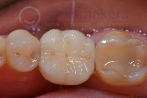 BackTeeth 3 After Compressed 300x200 2