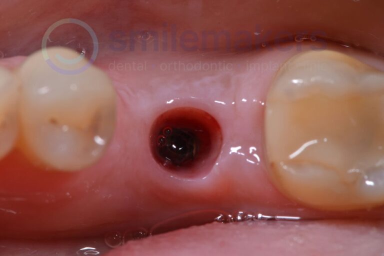 BackTeeth 3 Before Compressed 768x512 2