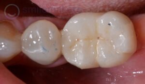 BackTeeth 4 After Compressed 300x174 2