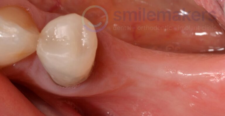 BackTeeth 4 Before Compressed 768x395 2