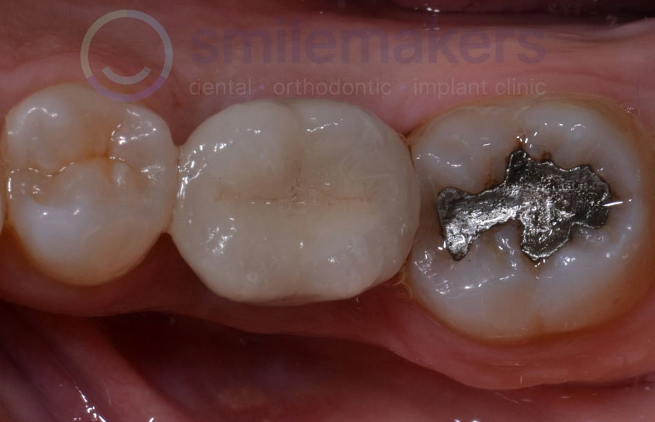 BackTeeth 5 After Compressed 1