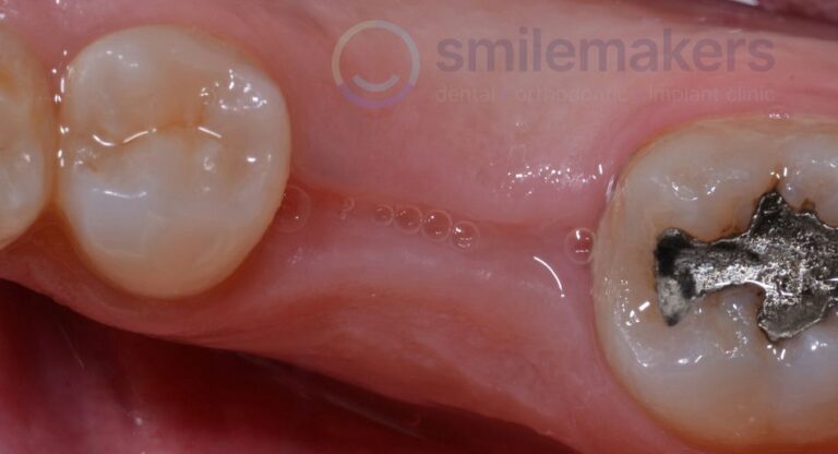BackTeeth 5 Before Compressed 768x416 2