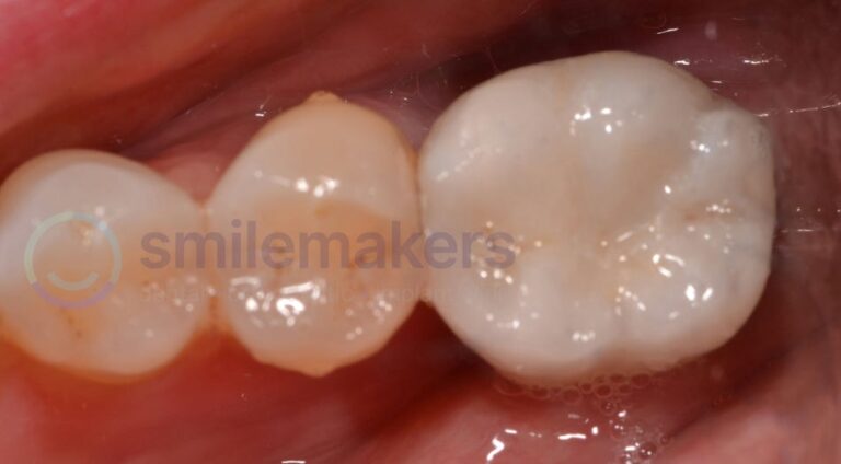 BackTeeth 6 After Compressed 768x424 2