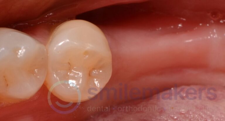 BackTeeth 6 Before Compressed 768x415 2