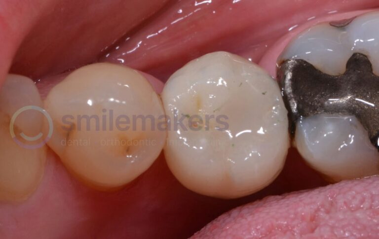 BackTeeth 7 After Compressed 768x485 2