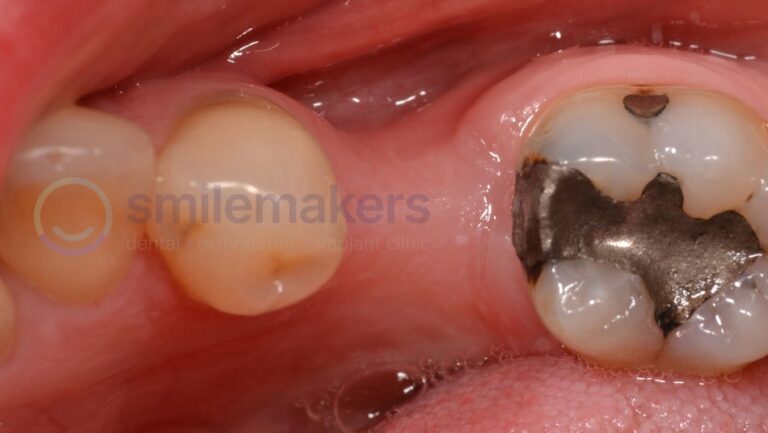 BackTeeth 7 Before Compressed 768x433 2
