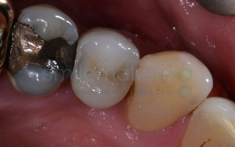 BackTeeth 8 After Compressed 768x479 2