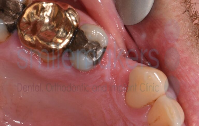 BackTeeth 8 Before Compressed 768x487 2