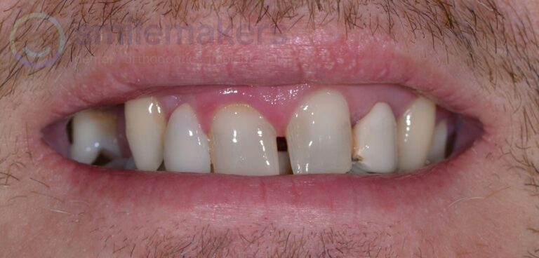 Combination 1 Before Compressed 768x368 2