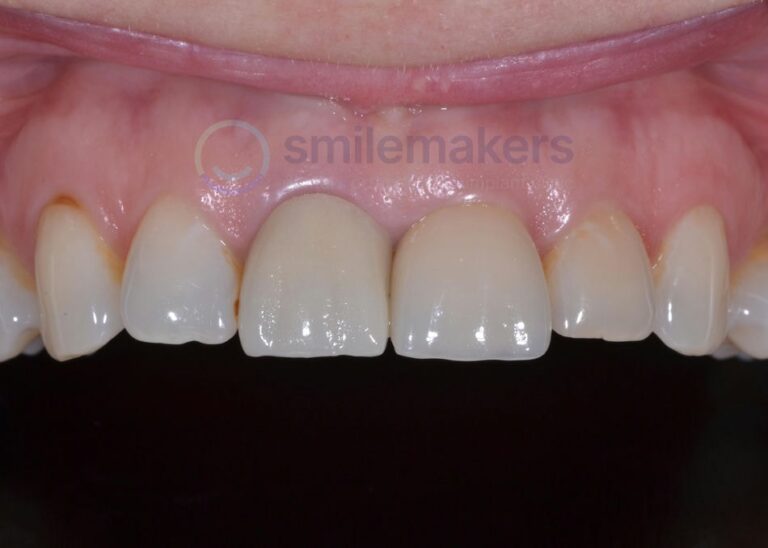 FrontTeeth 1 After Compressed 768x548 2