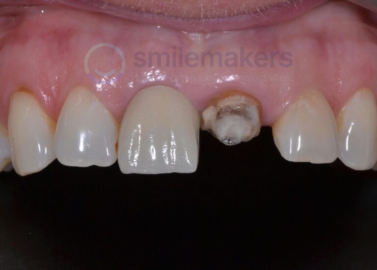 FrontTeeth 1 Before Compressed 768x549 2