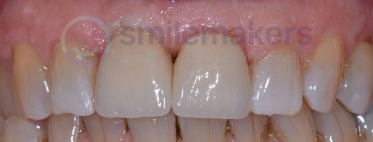 FrontTeeth 10 After Compressed 768x292 2