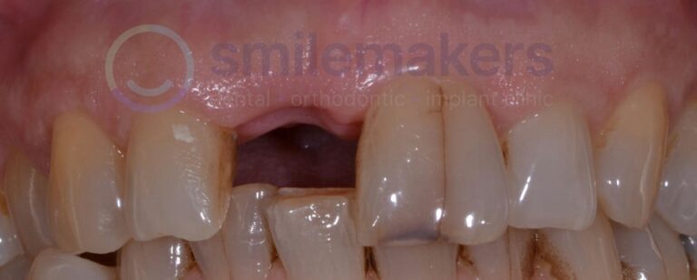 FrontTeeth 10 Before Compressed 768x309 2