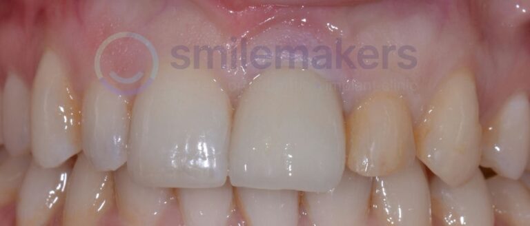 FrontTeeth 11 After Compressed 768x328 2