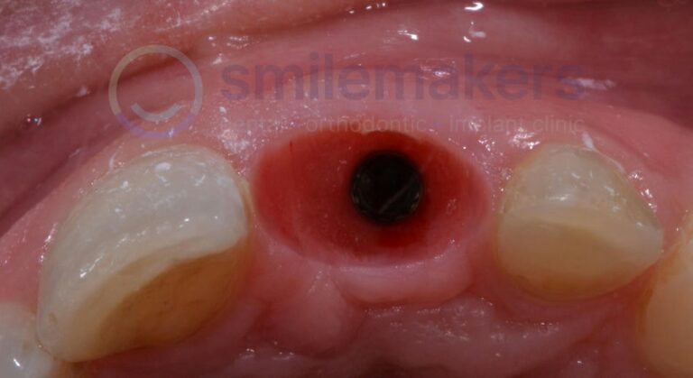 FrontTeeth 11 Before Compressed 768x419 2