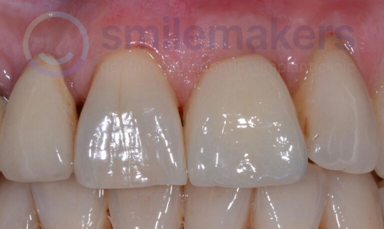 FrontTeeth 12 After Compressed 768x458 2