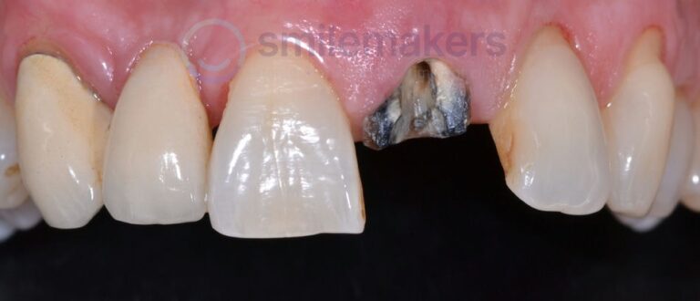 FrontTeeth 12 Before Compressed 768x330 2