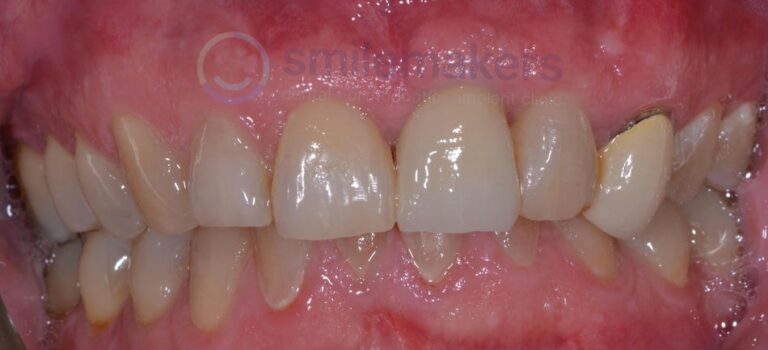 FrontTeeth 13 After Compressed 768x350 2
