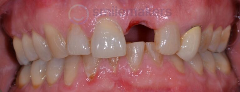 FrontTeeth 13 Before Compressed 768x295 2