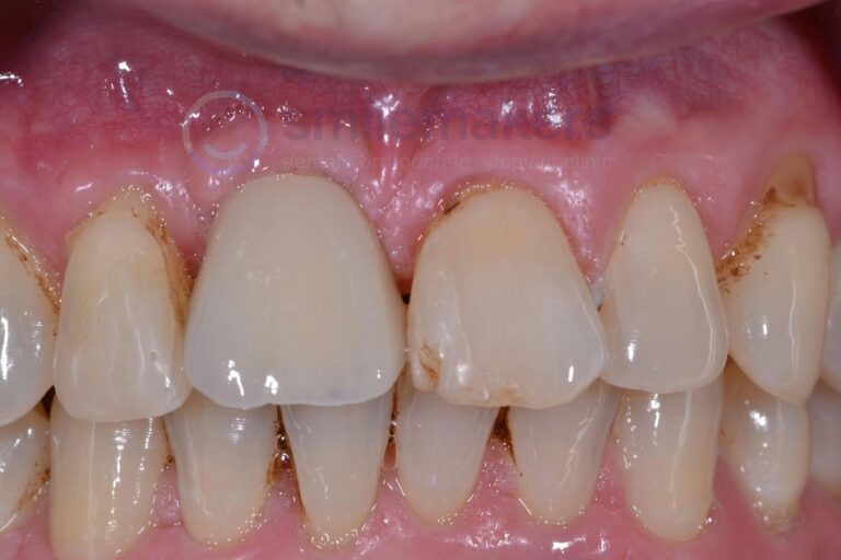 FrontTeeth 14 After Compressed 768x512 2