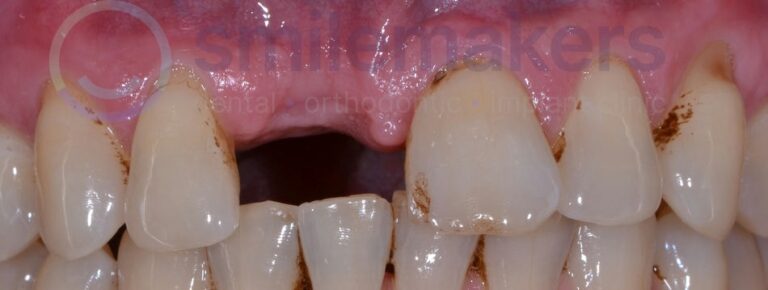 FrontTeeth 14 Before Compressed 768x290 2