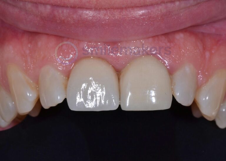 FrontTeeth 2 After Compressed 768x549 2