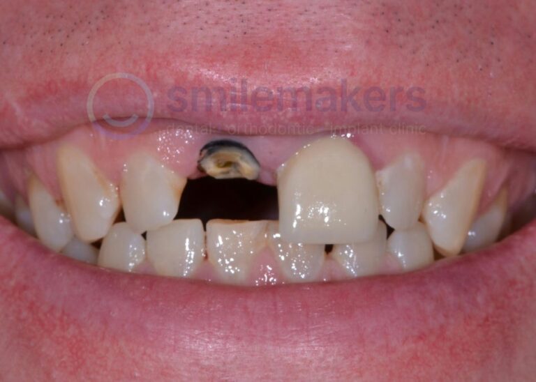 FrontTeeth 2 Before Compressed 768x548 2