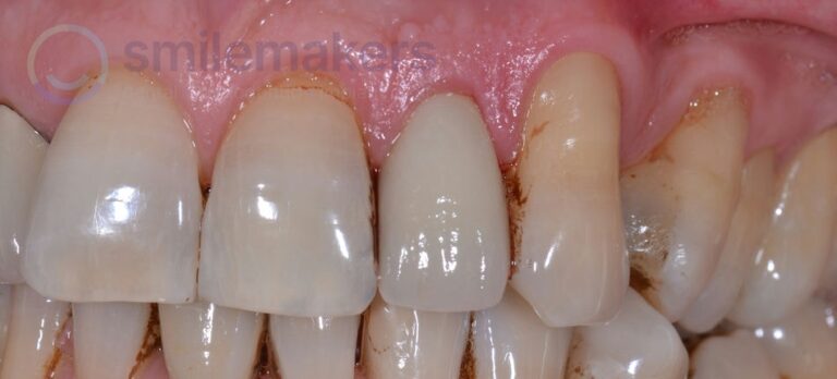 FrontTeeth 3 After Compressed 768x348 2