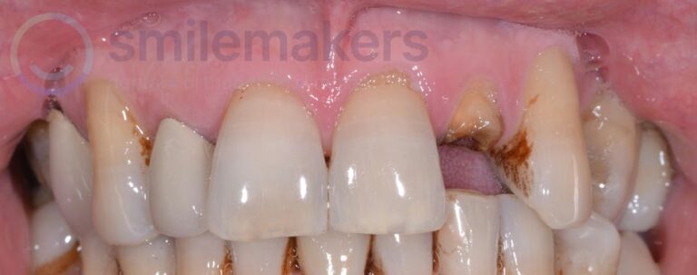FrontTeeth 3 Before Compressed 768x303 2