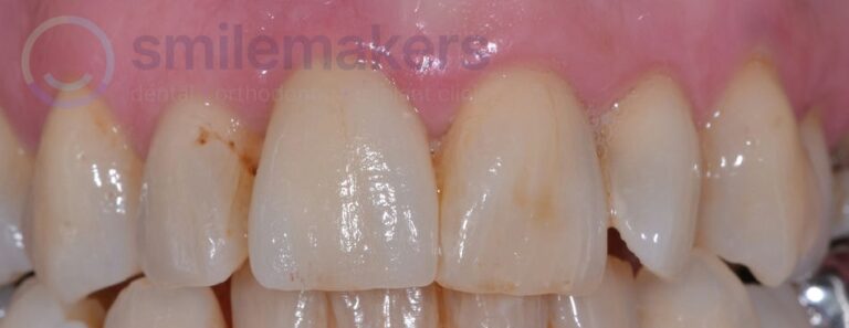 FrontTeeth 4 After Compressed 768x297 2