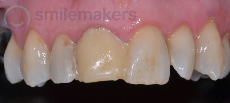 FrontTeeth 4 Before Compressed 768x345 2