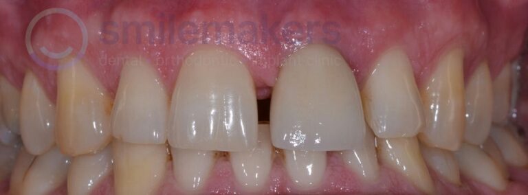 FrontTeeth 5 After Compressed 768x284 2