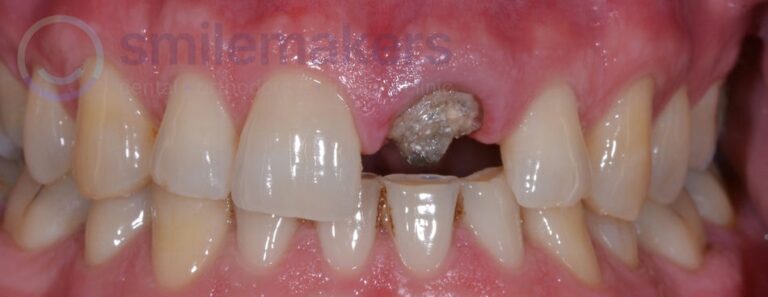 FrontTeeth 5 Before Compressed 768x297 2