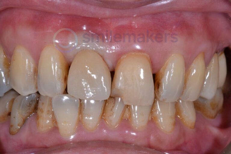 FrontTeeth 6 After Compressed 768x512 2