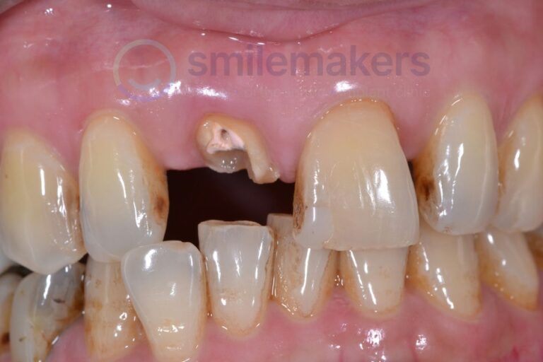 FrontTeeth 6 Before Compressed 768x512 2