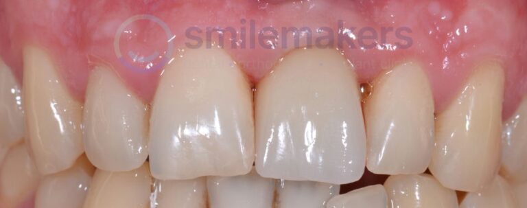 FrontTeeth 7 After Compressed 768x303 2