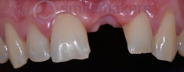 FrontTeeth 7 Before Compressed 768x300 2