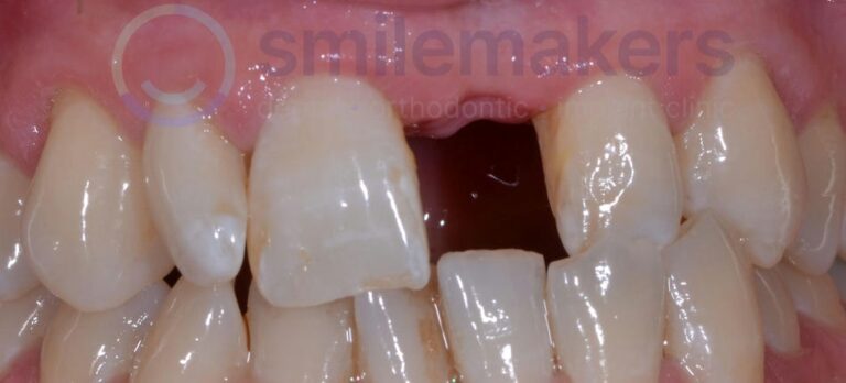 FrontTeeth 8 Before Compressed 768x348 2