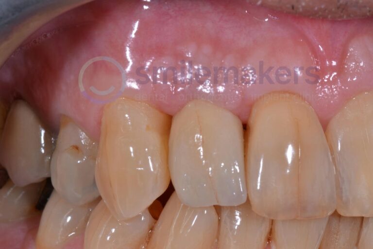 FrontTeeth 9 After Compressed 768x512 2