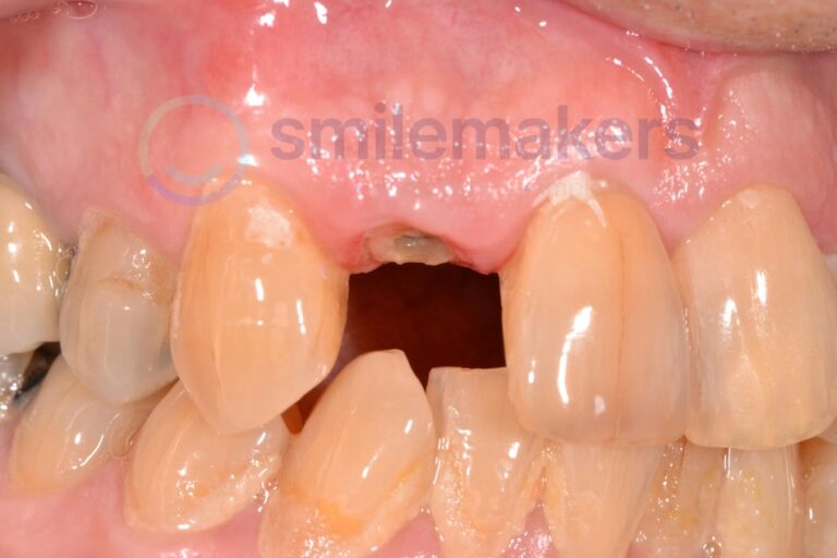 FrontTeeth 9 Before Compressed 768x512 2