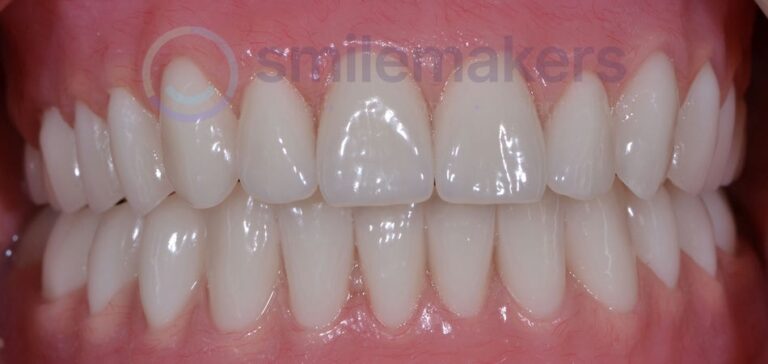 Overdentures 1 After Compressed 768x364 2