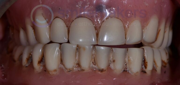 Overdentures 1 Before Compressed 768x363 2