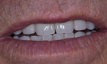 aftr5 3