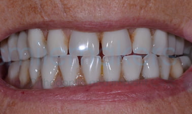 aftr6 3