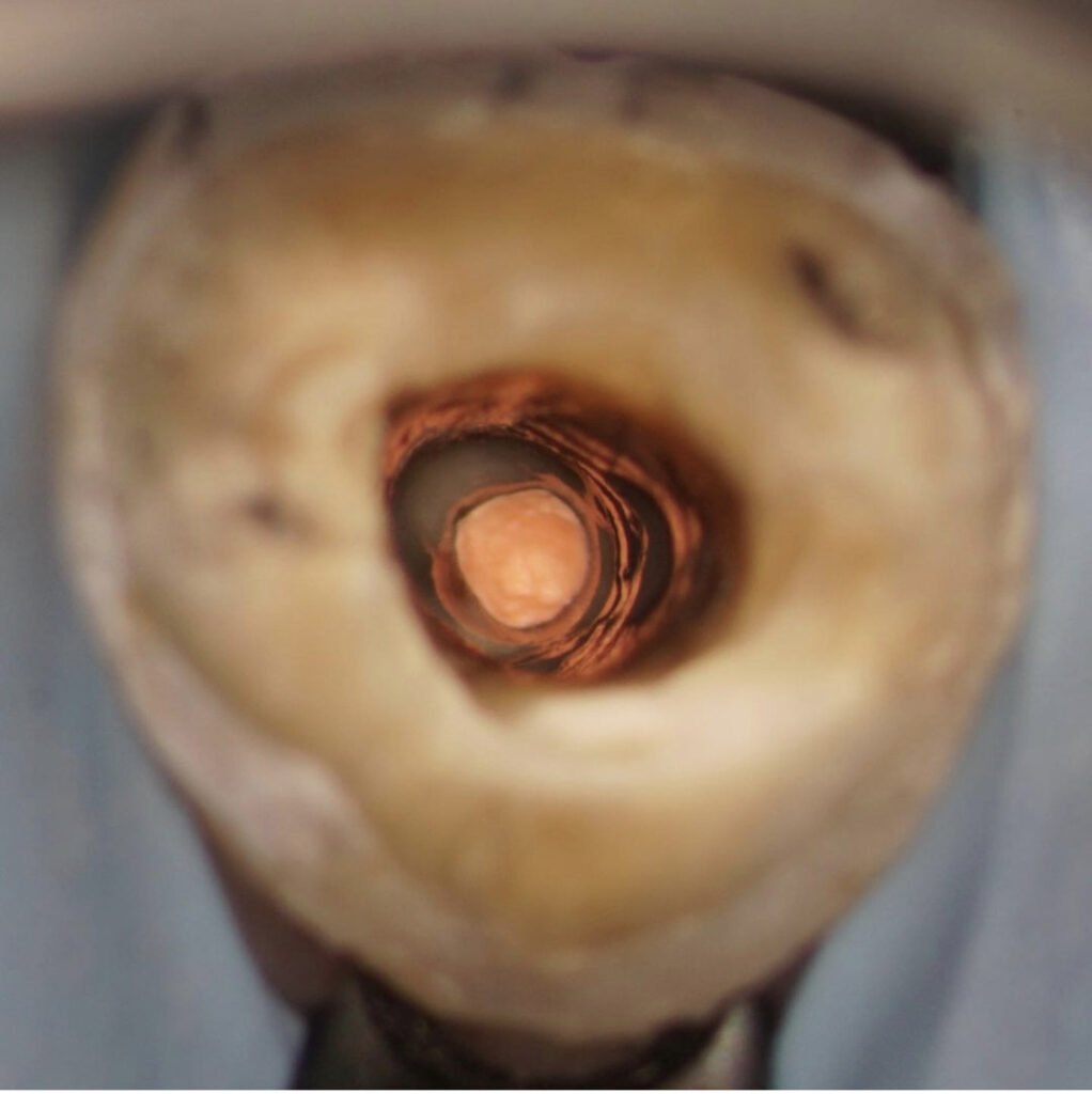 close up of root canal in decaying tooth